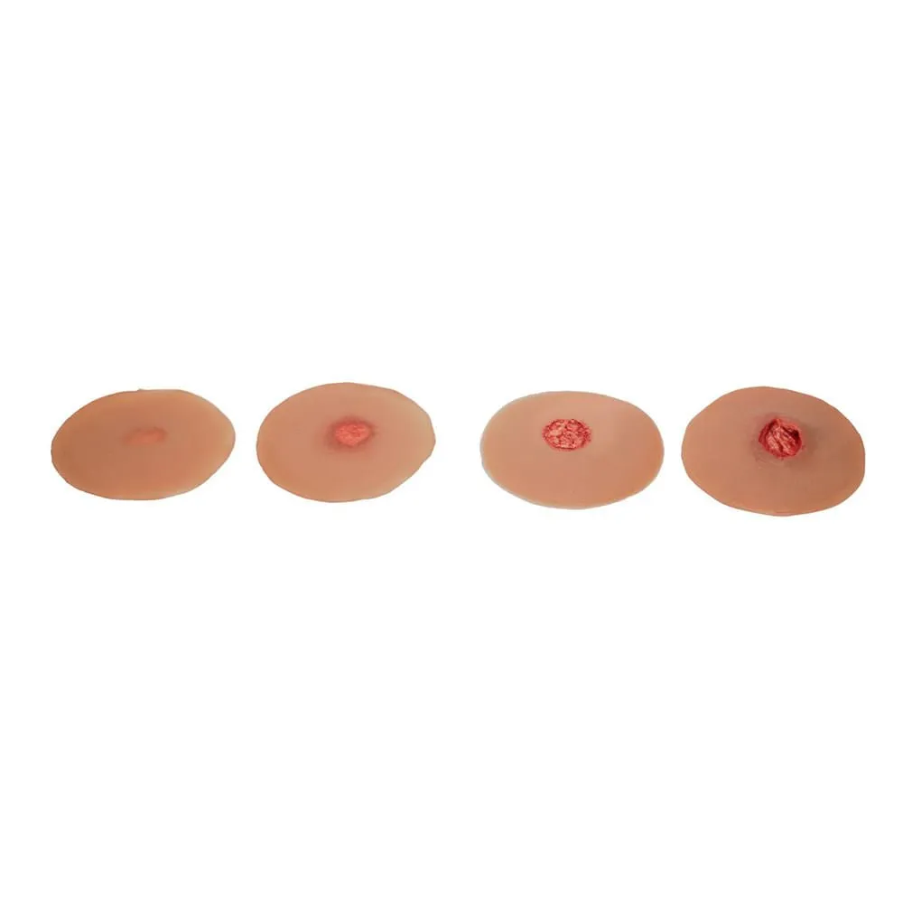 Pressure Ulcer Sticky Wound Kit