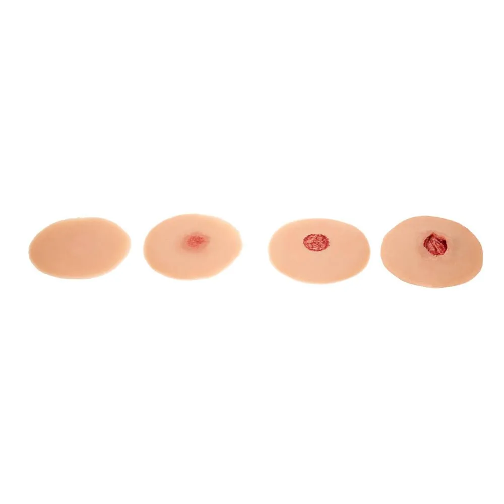 Pressure Ulcer Sticky Wound Kit